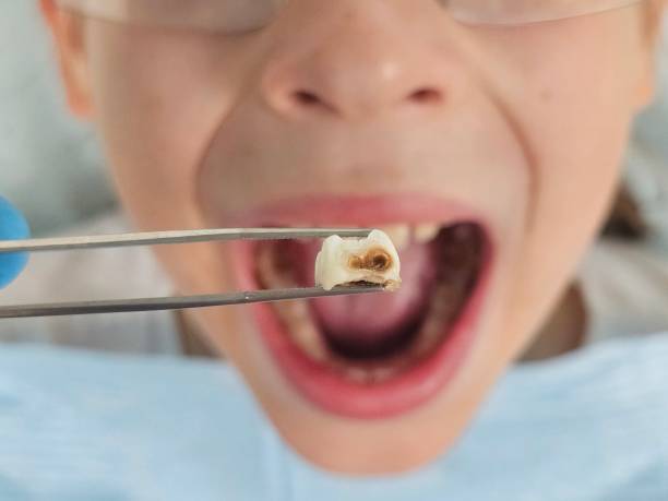Best Broken or Cracked Tooth Emergency Dentist in Terre Du Lac, MO